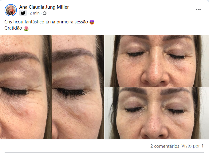 Resultado Fios de Sustentação não Invasivos
